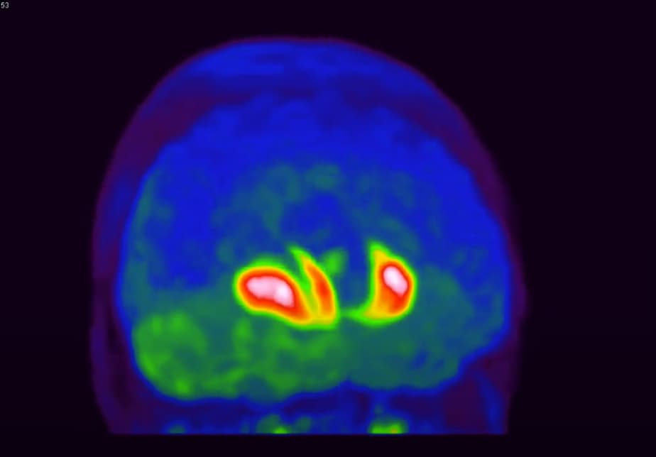 18F-DOPA use in Parkinsonism